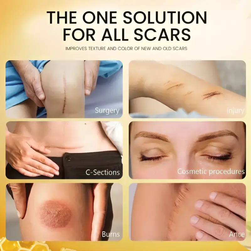 جل علاج الندبات وإزالة علامات التمدد - الصورة 3